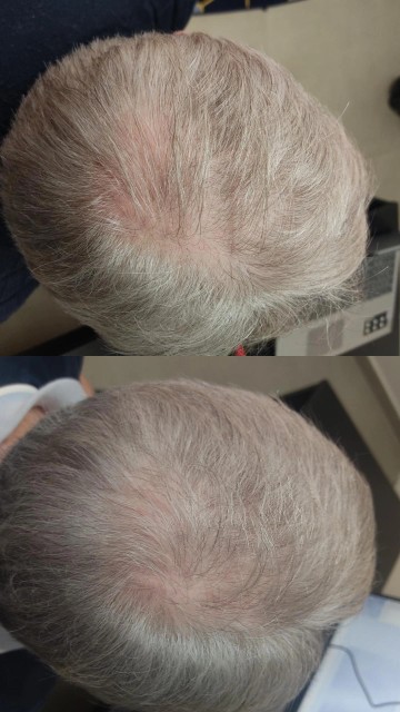 Resultado Capilar – Antes e Depois 1
