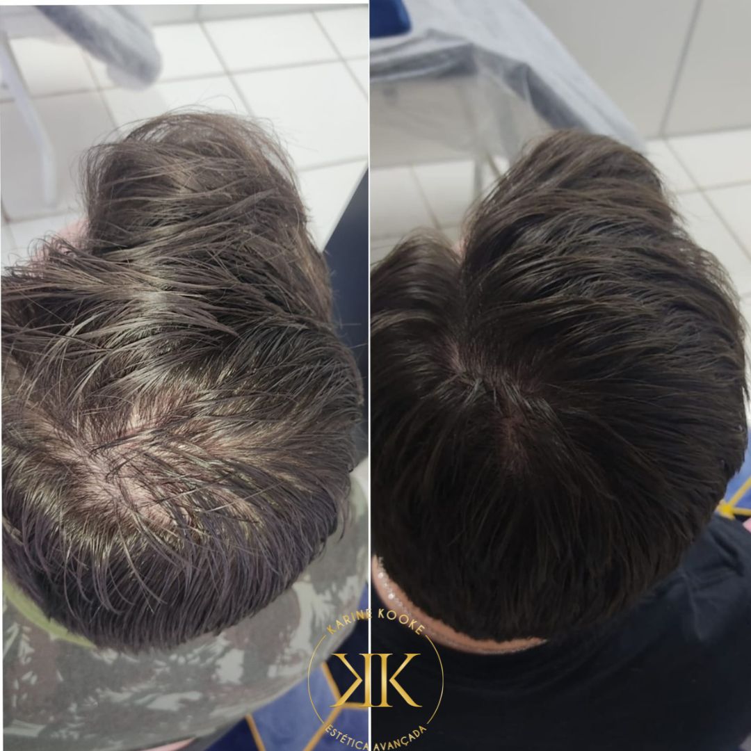 Resultado Capilar – Antes e Depois 2