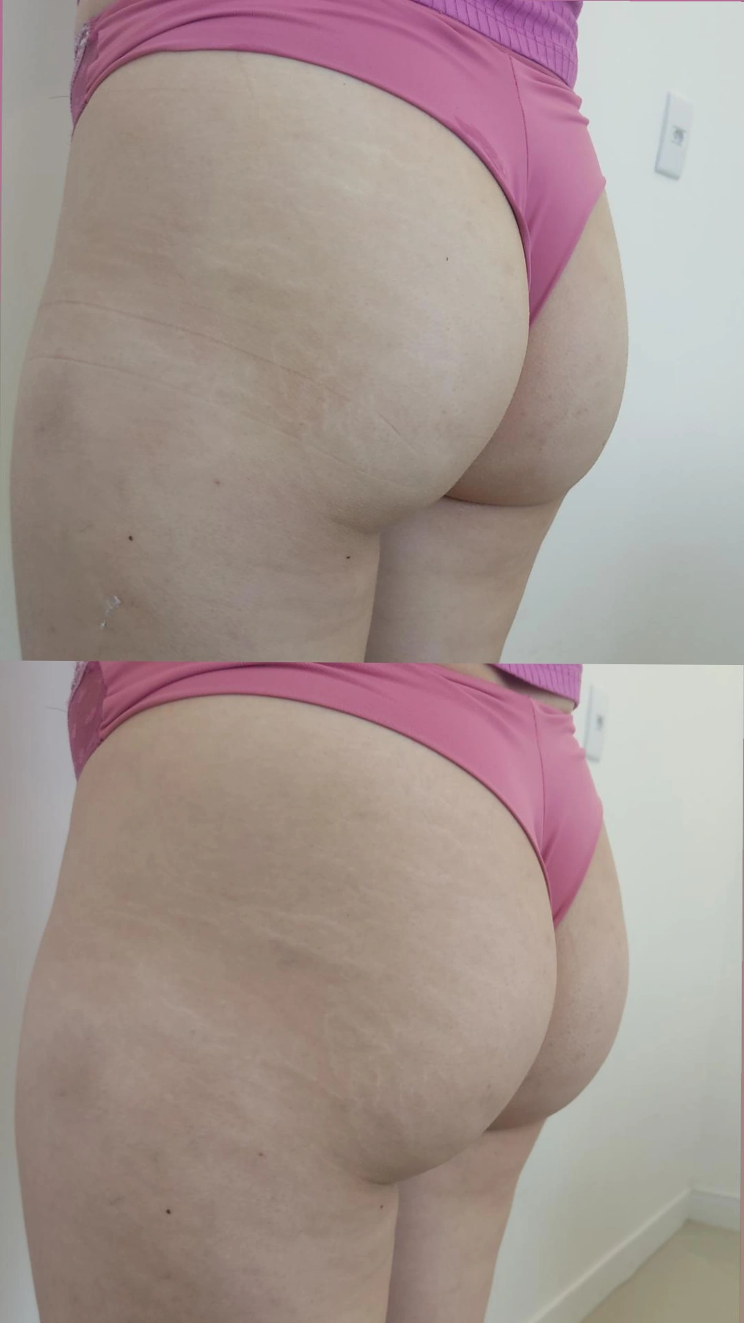 Lifting de Glúteos – Antes e Depois